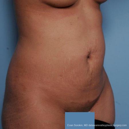 Philadelphia Abdominoplasty 9479 - Before Image 2