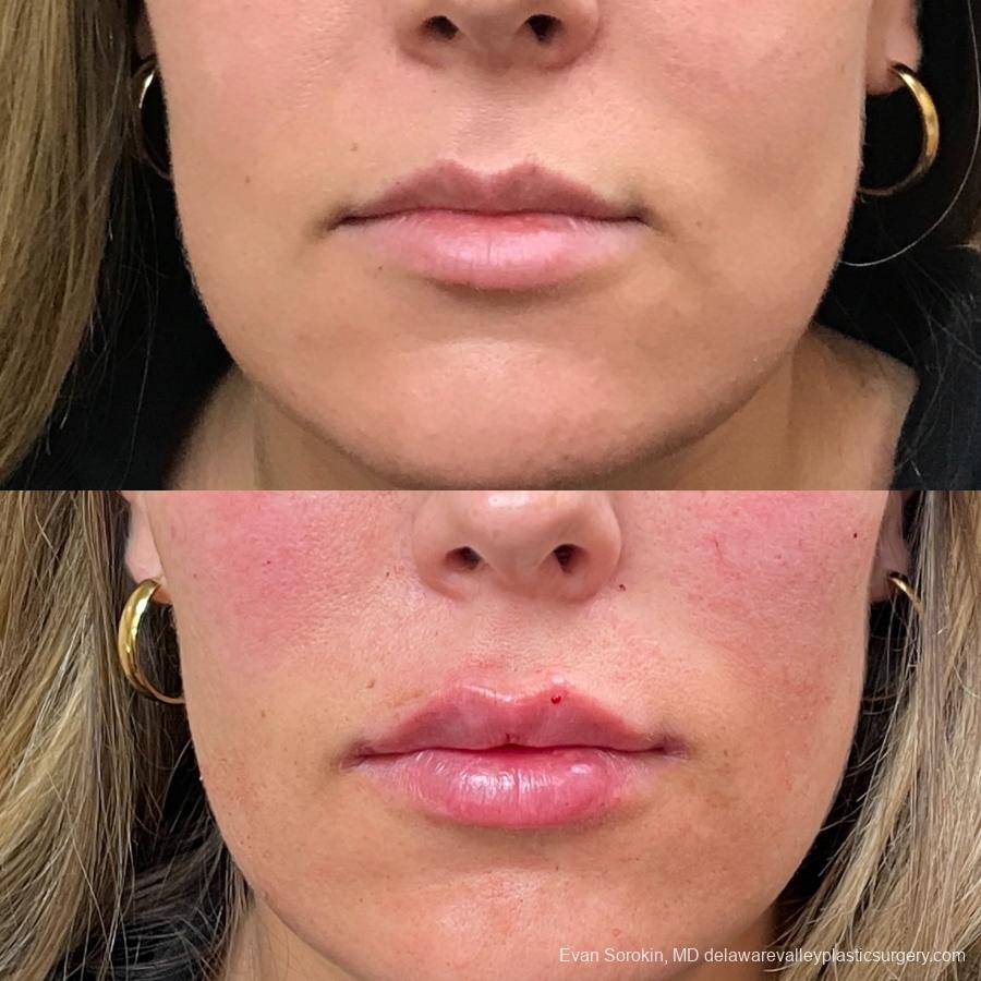 Lip Augmentation: Patient 28 - Before and After 1