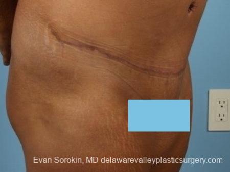 Philadelphia Abdominoplasty 8700 - After Image 2