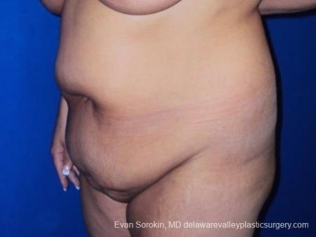 Philadelphia Abdominoplasty 8700 - Before Image 3