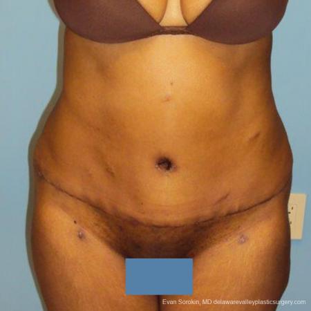 Philadelphia Abdominoplasty 9472 - After Image 1