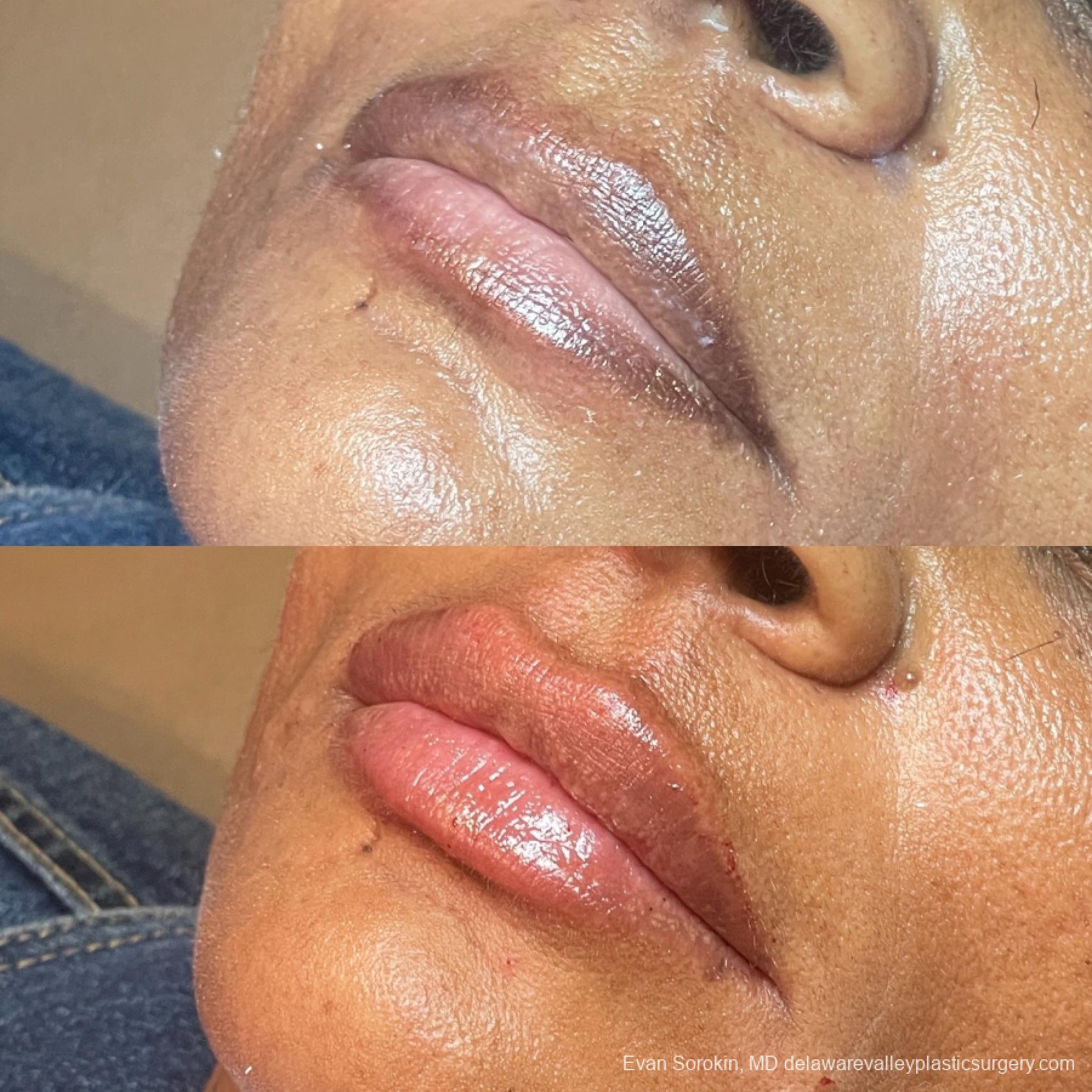 Lip Augmentation: Patient 65 - Before and After 3