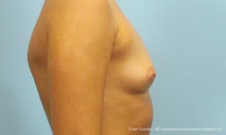 Philadelphia Breast Augmentation 9183 - Before Image 3