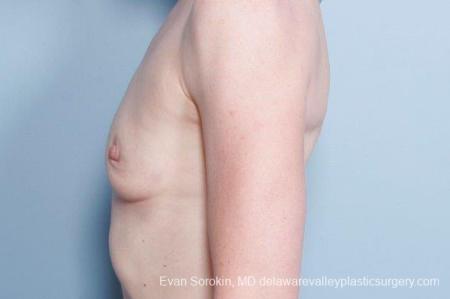 Philadelphia Breast Augmentation 9169 - Before and After Image 5