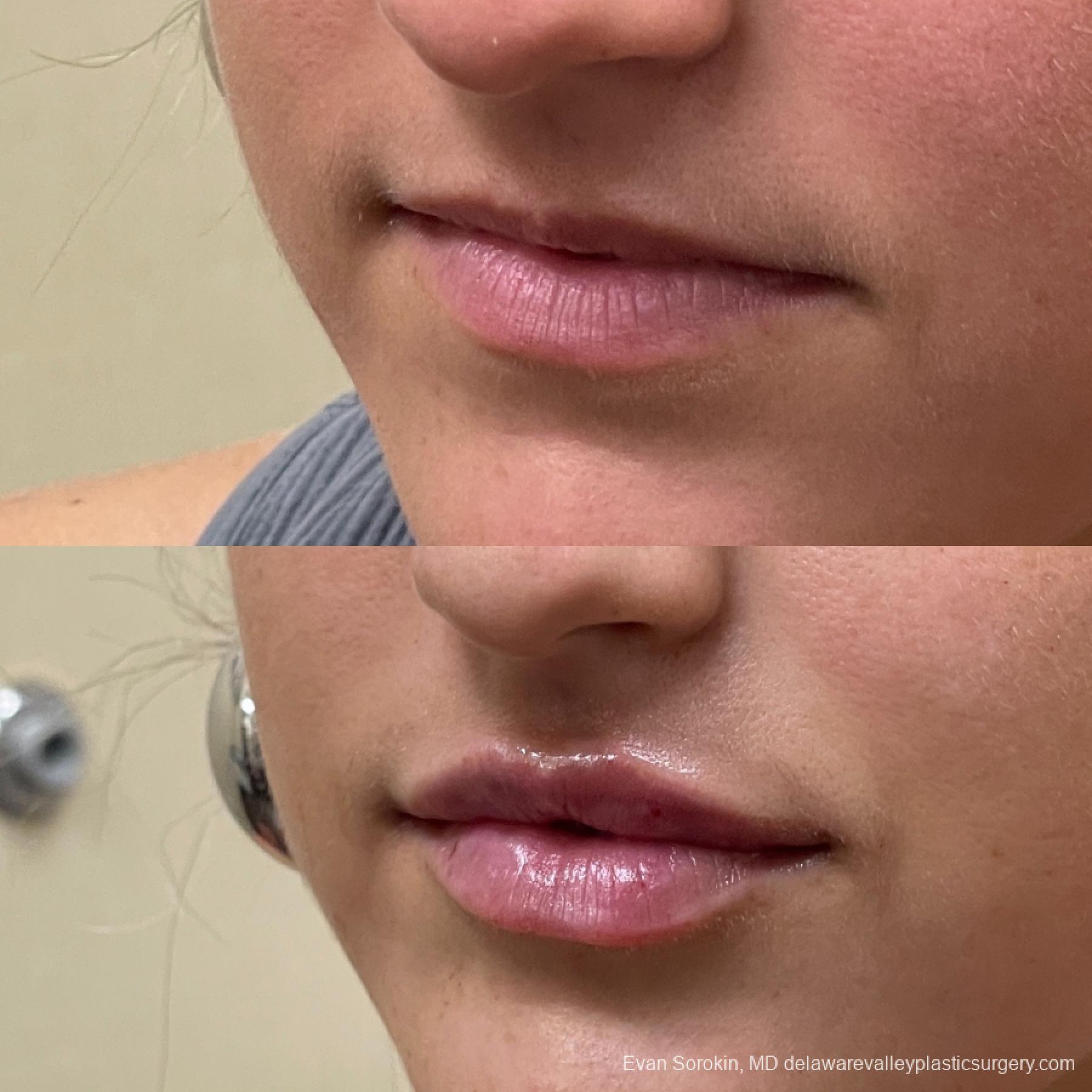 Lip Augmentation: Patient 13 - Before and After 3