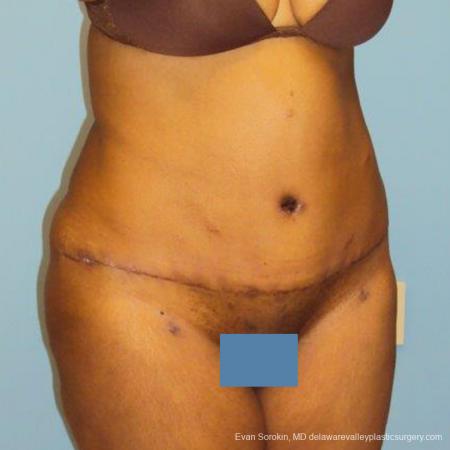 Philadelphia Abdominoplasty 9472 - After Image 2