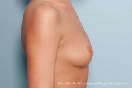 Philadelphia Breast Augmentation 8792 - Before Image 4
