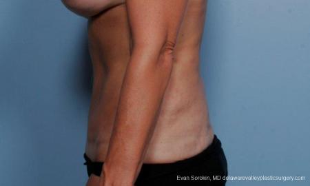 Philadelphia Abdominoplasty 9376 - After Image 5