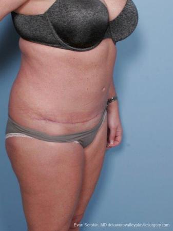 Philadelphia Abdominoplasty 9463 - After Image 2