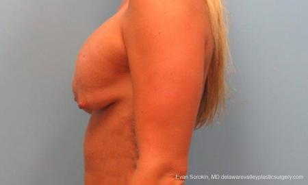 Philadelphia Breast Lift and Augmentation 9370 - Before Image 3