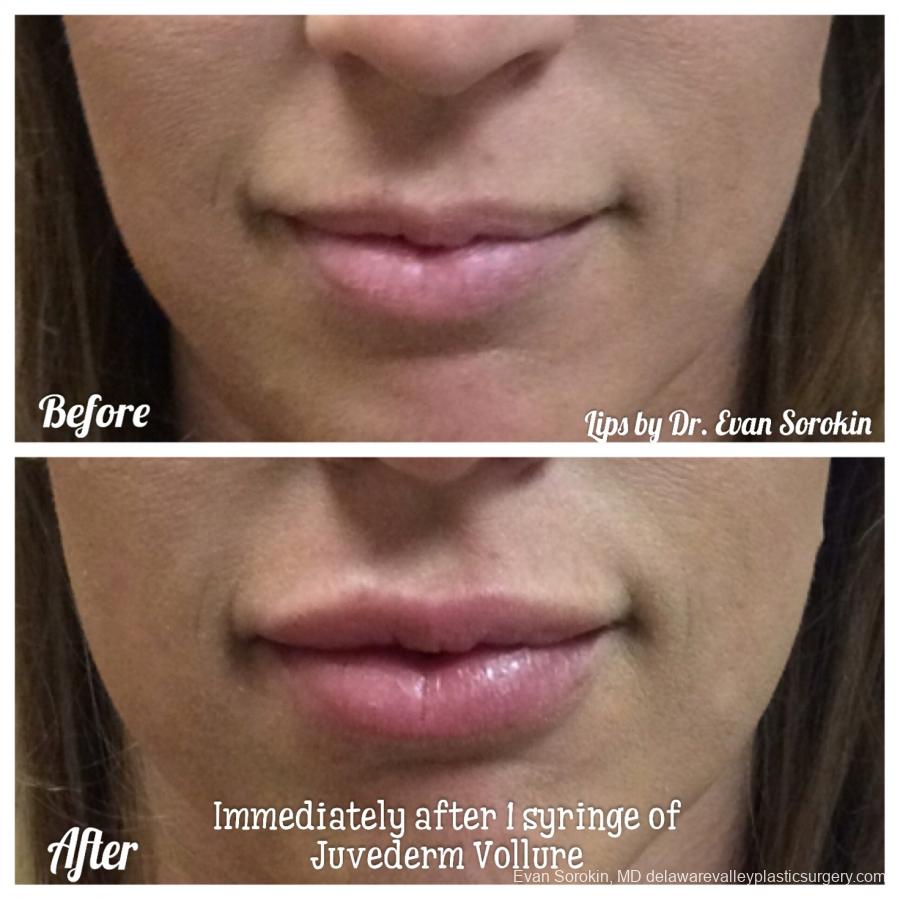 Lip Augmentation: Patient 2 - Before and After Image 1