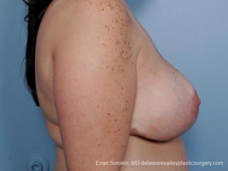Philadelphia Breast Reduction 8703 - After Image 5