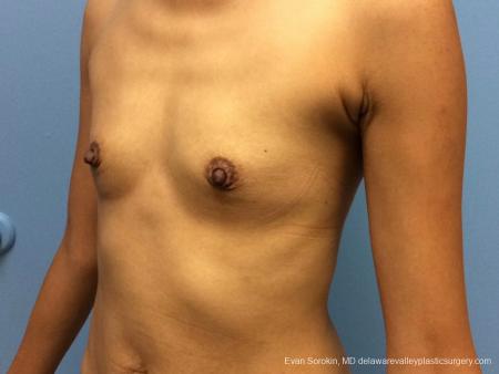 Philadelphia Breast Augmentation 13071 - Before Image 3