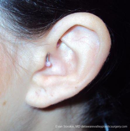 Philadelphia Earlobe Surgery 9384 - After Image 2