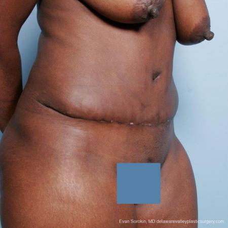 Philadelphia Abdominoplasty 9477 - After Image 2