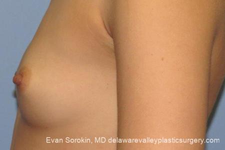 Philadelphia Breast Augmentation 10097 - Before and After Image 5