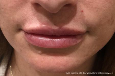 Lip Augmentation: Patient 12 - After Image 1