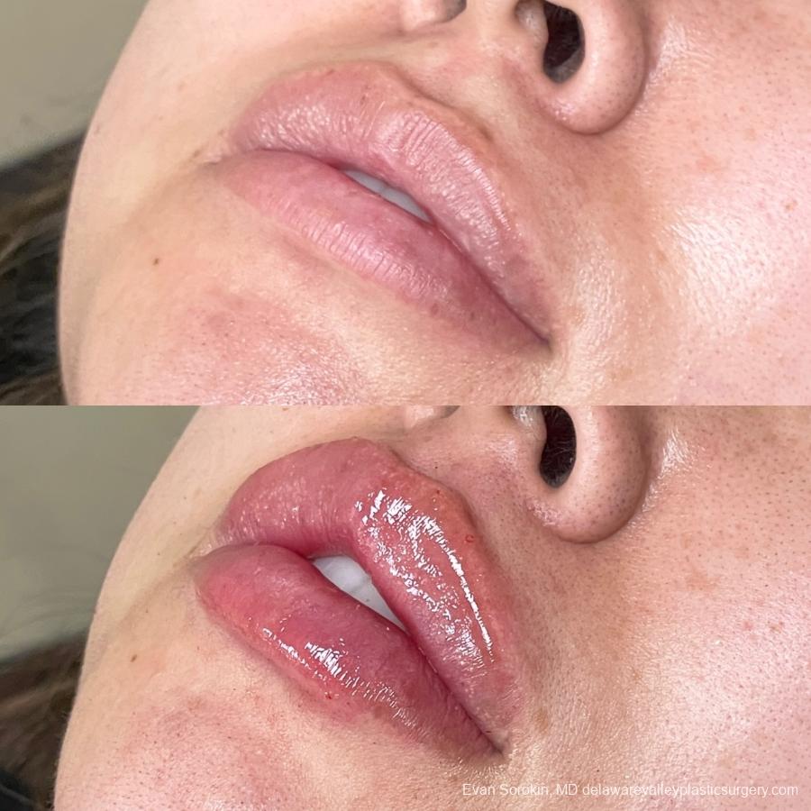 Lip Filler: Patient 24 - Before and After 3