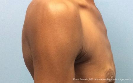 Philadelphia Breast Augmentation 13072 - Before 3