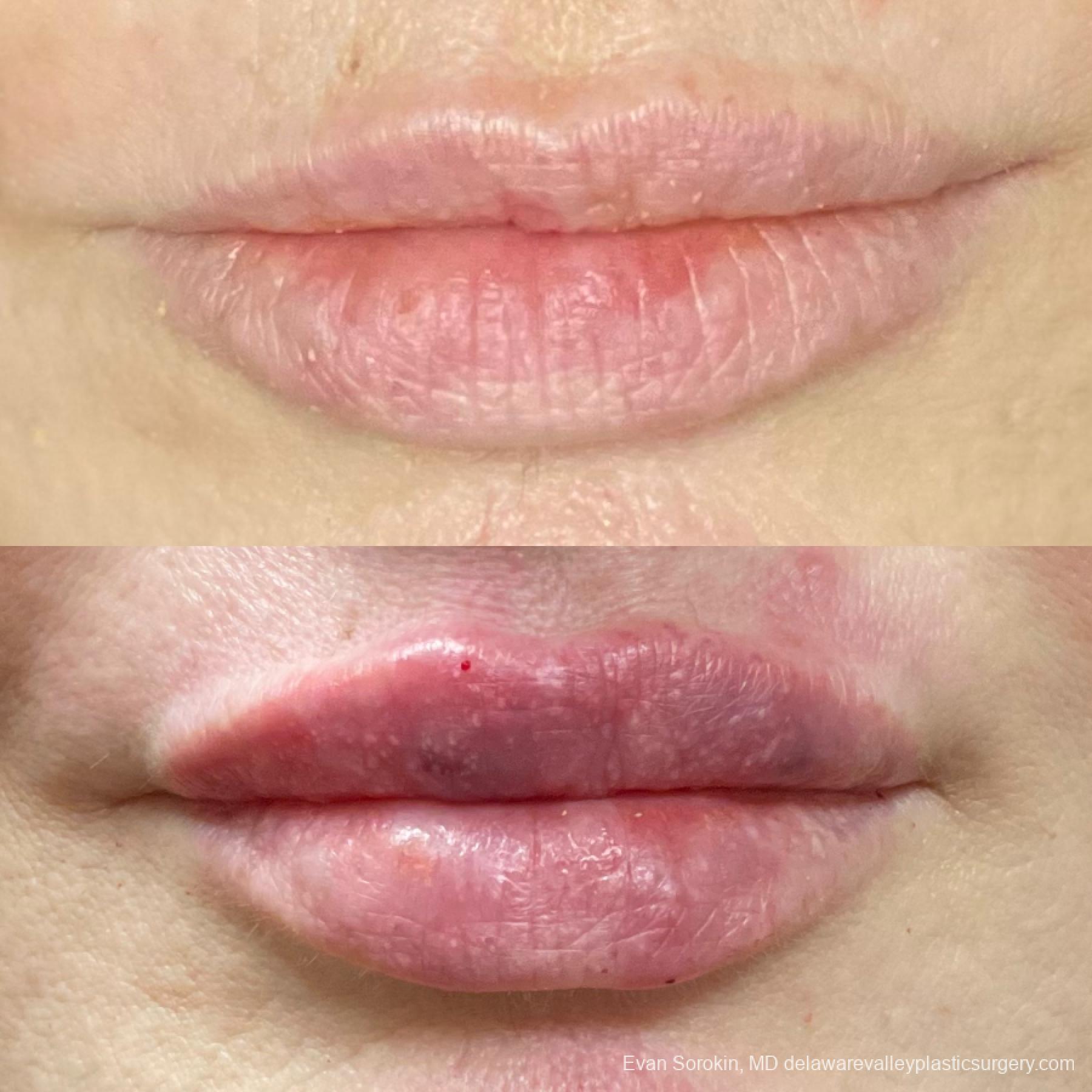 Fillers: Patient 14 - Before and After 