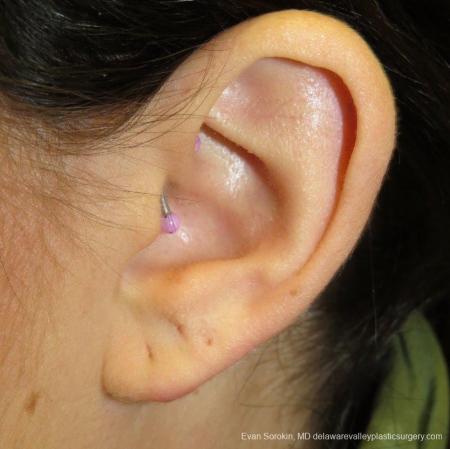 Philadelphia Earlobe Surgery 9384 - Before and After Image 4