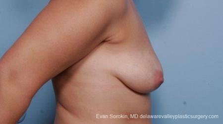 Philadelphia Breast Lift and Augmentation 8702 - Before and After Image 4