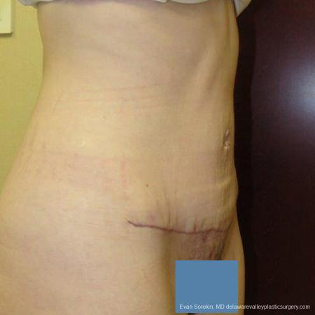 Philadelphia Abdominoplasty 9465 - After Image 2