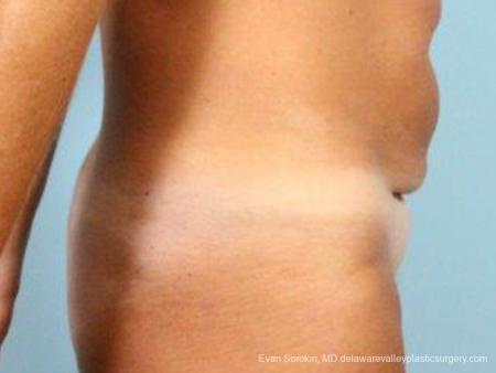 Philadelphia Abdominoplasty 9464 - Before Image 3