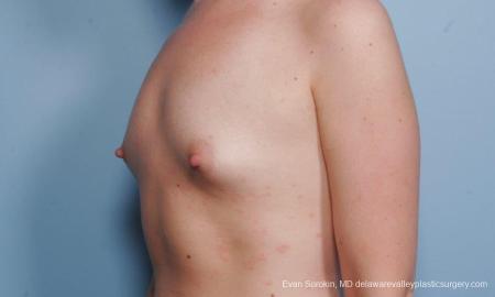 Philadelphia Breast Augmentation 9176 - Before Image 4