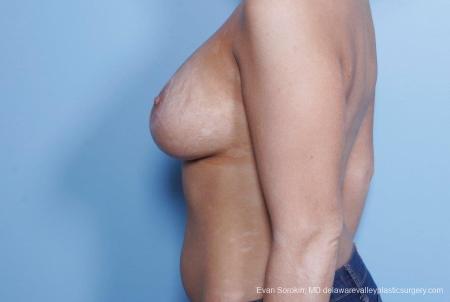 Philadelphia Breast Lift and Augmentation 8688 - After Image 5
