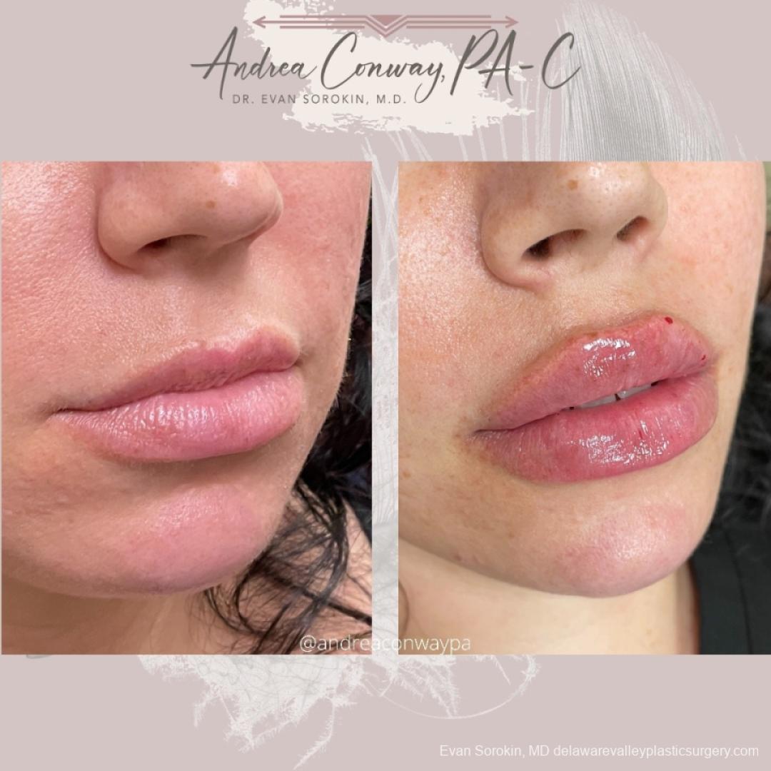 Lip Augmentation: Patient 24 - Before and After 