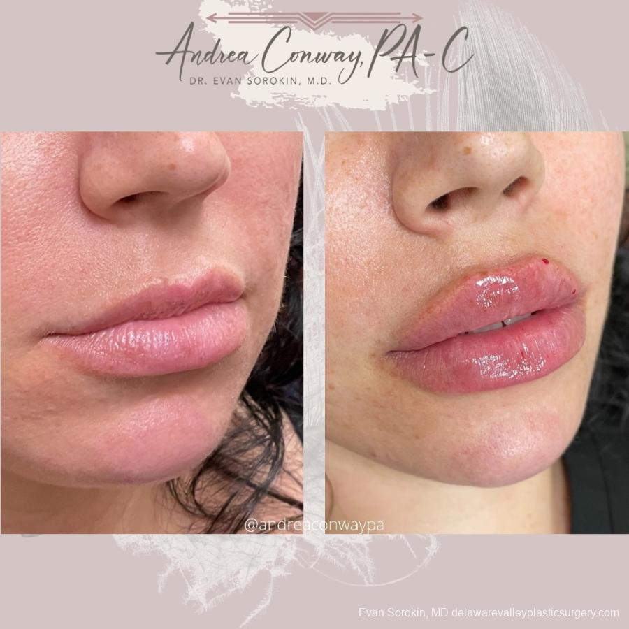 Lip Augmentation: Patient 24 - Before and After 1