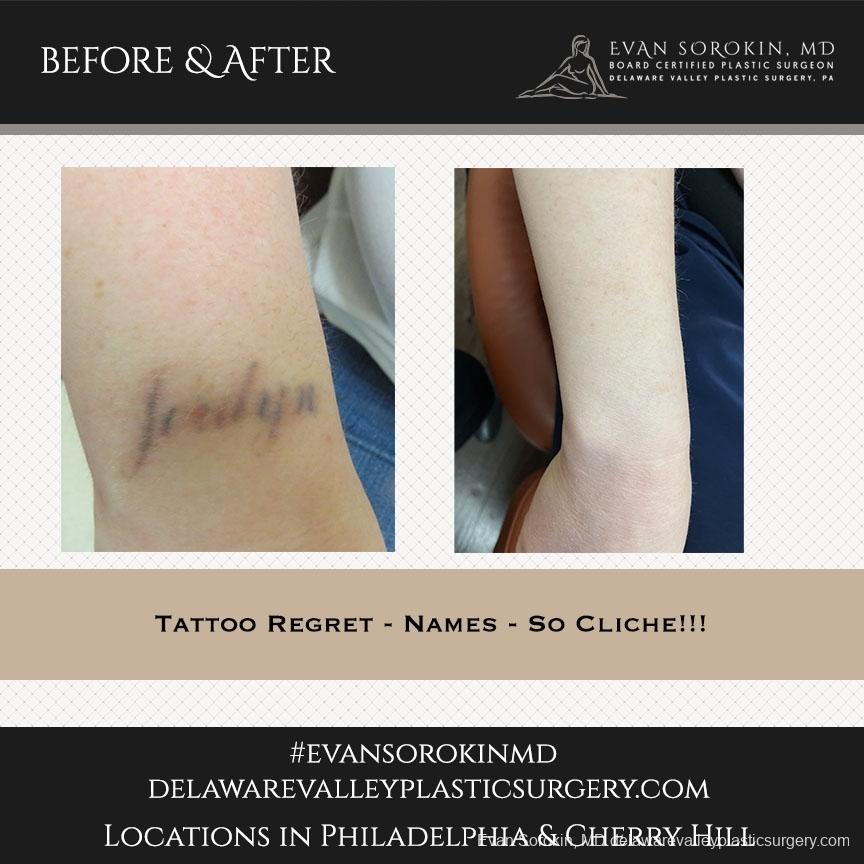 Tattoo Removal: Patient 7 - Before and After Image 1