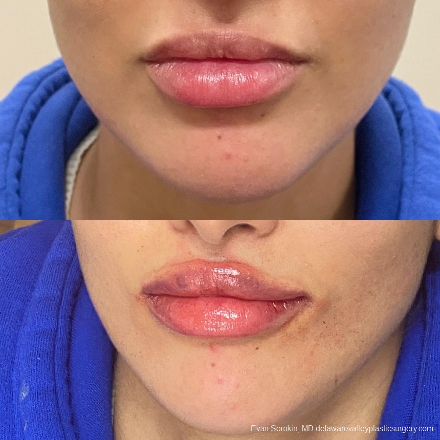 Lip Filler: Patient 1 - Before and After  