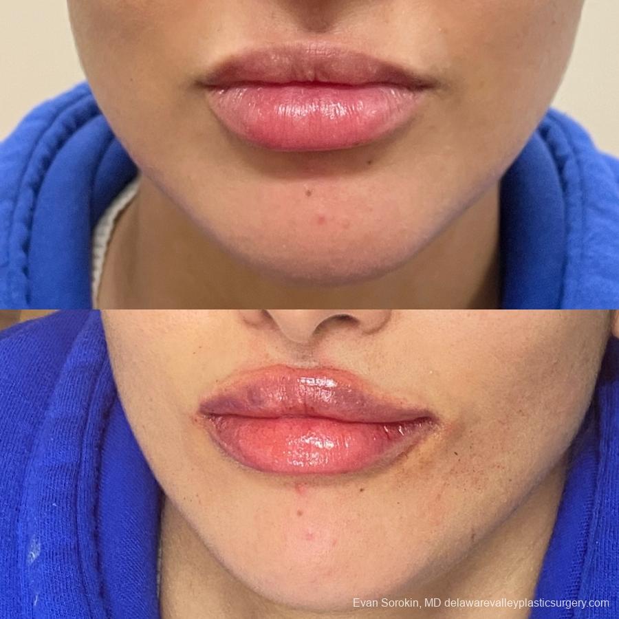 Lip Filler: Patient 1 - Before and After  
