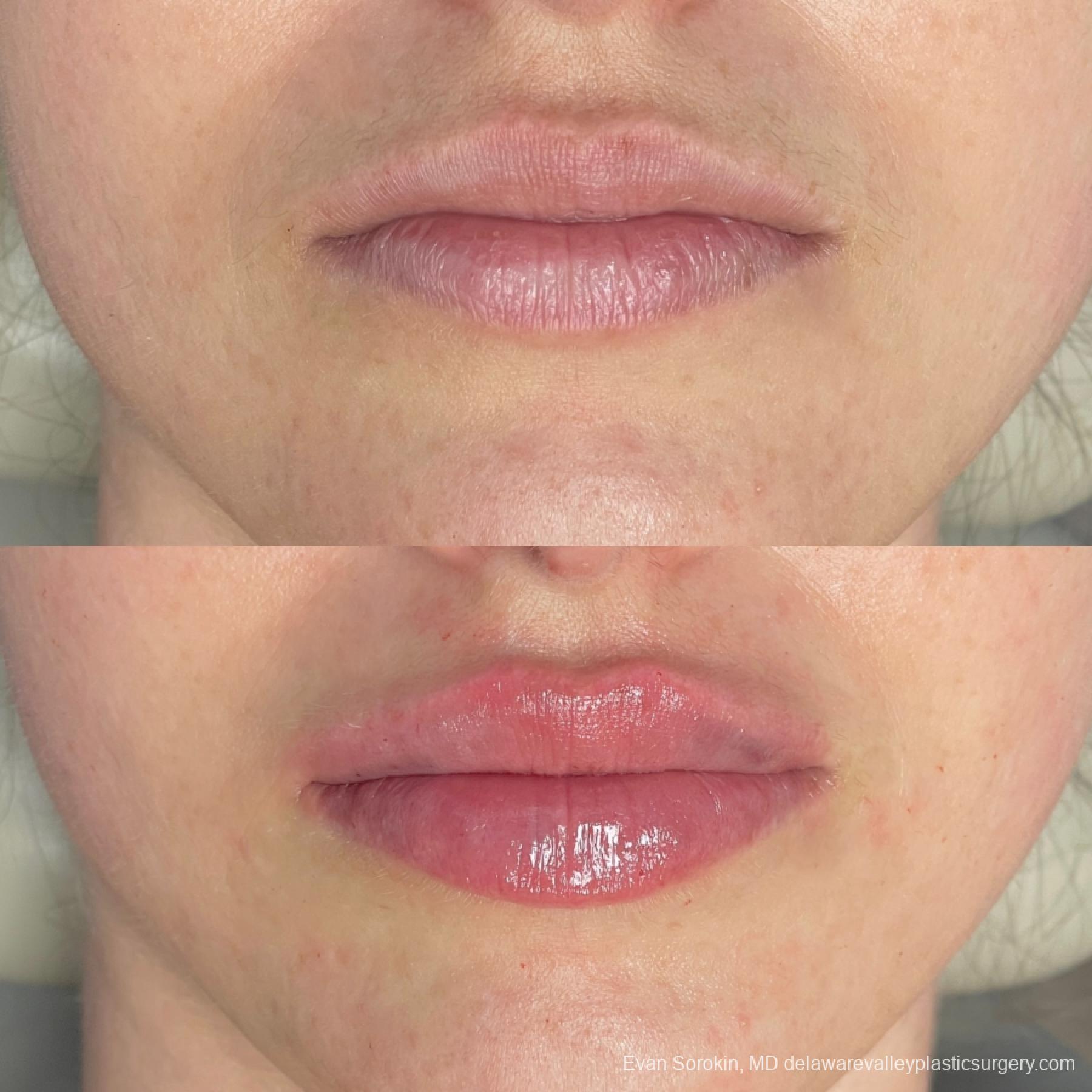 Lip Augmentation: Patient 59 - Before and After 1