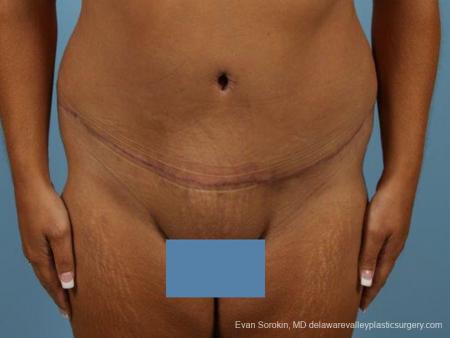 Philadelphia Abdominoplasty 9471 - After Image 1