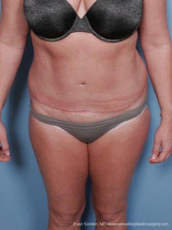 Philadelphia Abdominoplasty 9463 - After Image 1