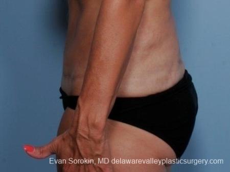 Philadelphia Abdominoplasty 8682 - After Image 5