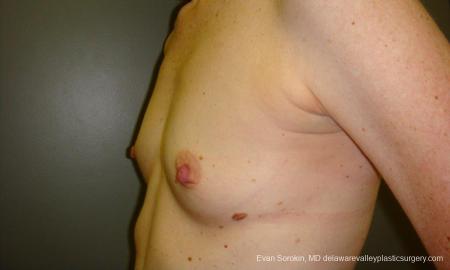 Philadelphia Breast Augmentation 9180 - Before and After Image 5