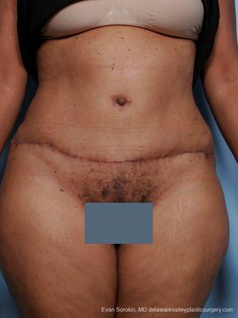 Philadelphia Abdominoplasty 9461 - After Image 1