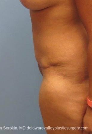 Philadelphia Abdominoplasty 8825 - After Image 3