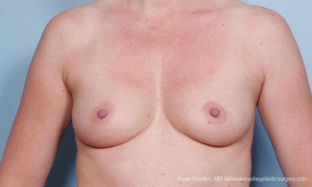 Philadelphia Breast Augmentation 9178 - Before Image 1