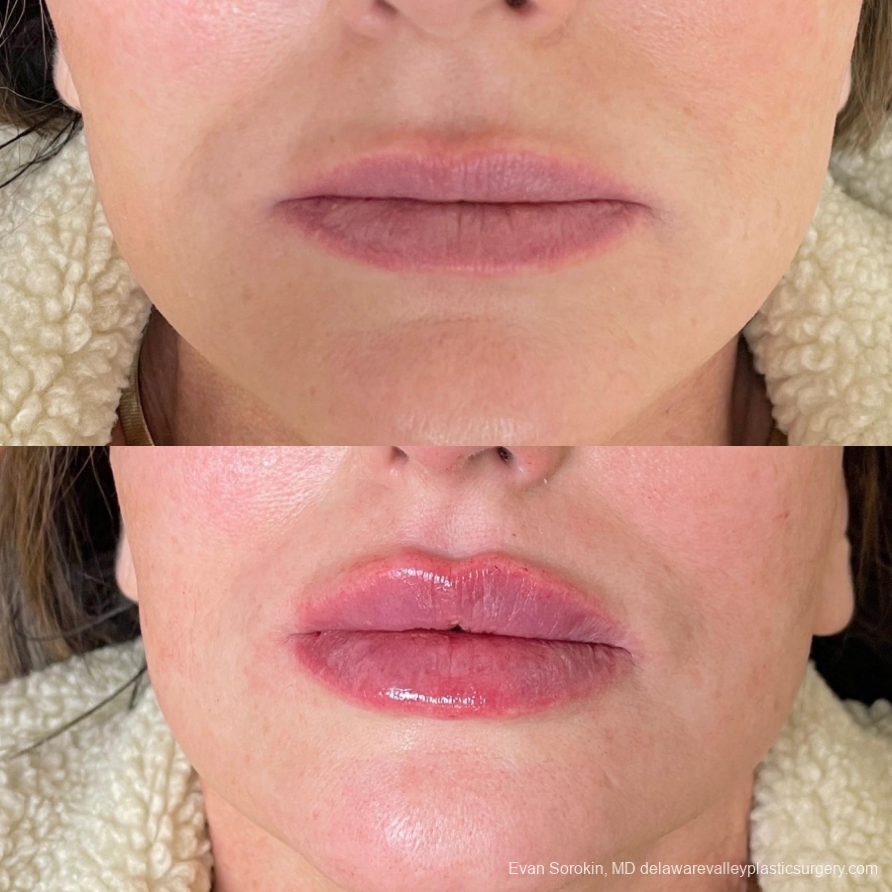 Lip Filler: Patient 63 - Before and After 1