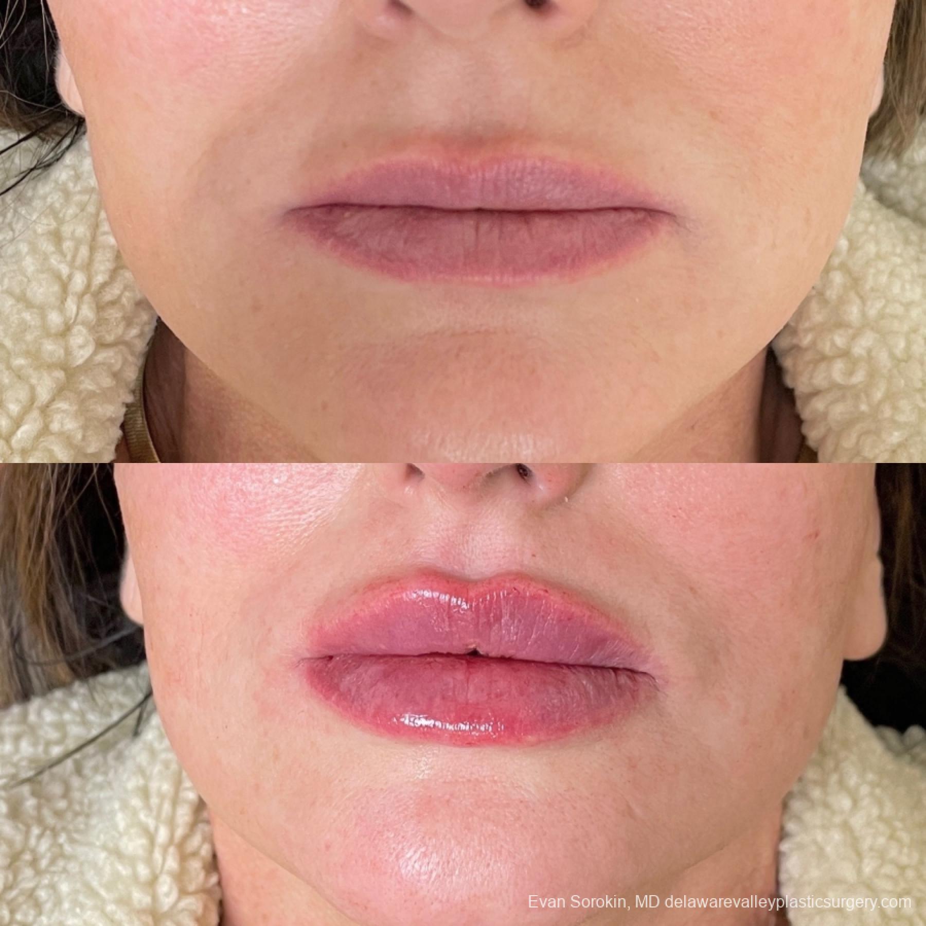 Lip Filler: Patient 62 - Before and After 1