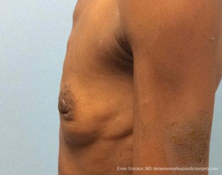 Philadelphia Breast Augmentation 13072 - Before and After 5
