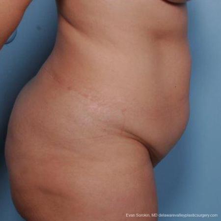 Philadelphia Liposuction 9481 - Before Image 3