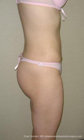 Philadelphia Liposuction 9480 - After Image 3