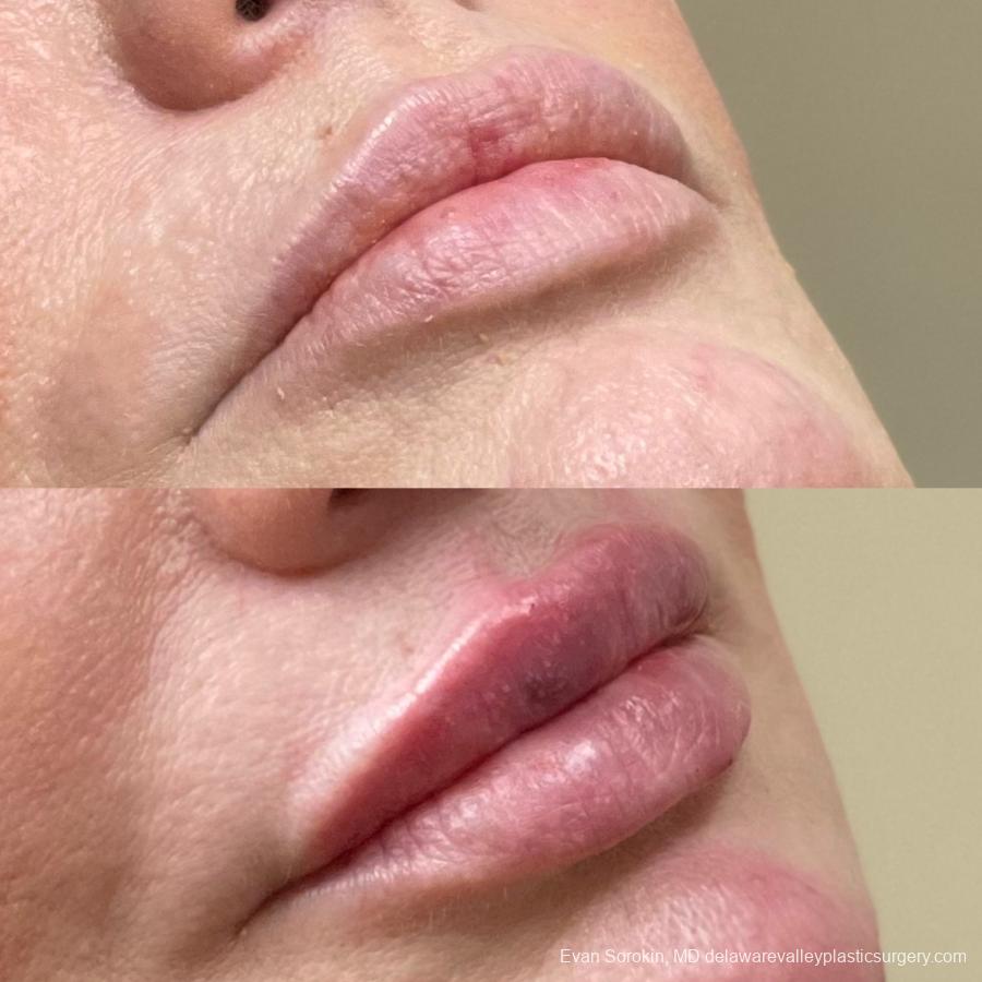 Lip Filler: Patient 40 - Before and After 2