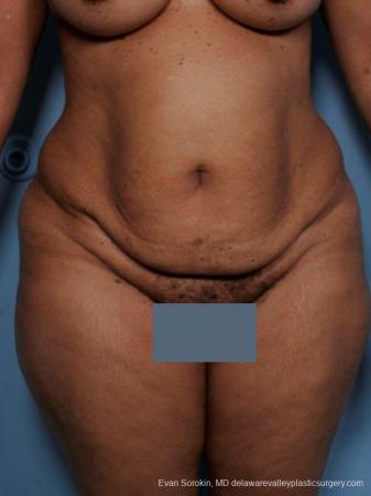 Philadelphia Abdominoplasty 9461 - Before Image 1